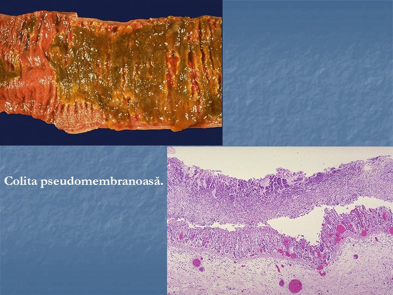 Colita pseudomembranoasă.